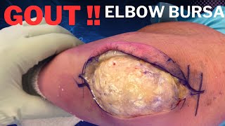 Elbow Olecranon Bursitis Gout Treated in 3 minutes [upl. by Ikciv348]