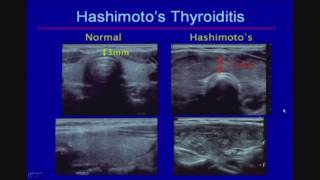 Sonographic Evaluation of Diffuse Thyroid Disease [upl. by Coughlin]