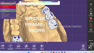 Bridges Maxilar and mandibular Arches [upl. by Davenport]