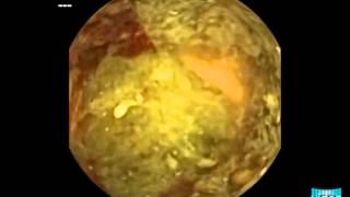 Small Bowel Capsule Endoscopy Visualizing Colonic Adenocarcinoma [upl. by Ylus]