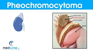 Pheochromocytoma causespathophysiologysymptoms and treatment [upl. by Flam475]