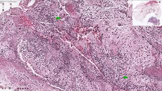 Osteosarcoma  Histopathology [upl. by Nariko]