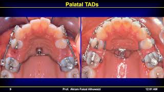 TADs 2018 Part 7 Onplants and plates Live in Arabic [upl. by Malamud656]