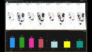 Lesion tracking through time in Hermia Multimodality Viewer [upl. by Seraphina]