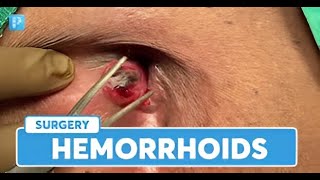 Hemorrhoids What They Are and How to Treat Them Easily [upl. by Mooney]