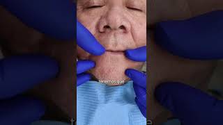 🦷 Implantes en maxilar superior e inferior para una sonrisa renovada ✨ implantesdentales shorts [upl. by Jillayne84]