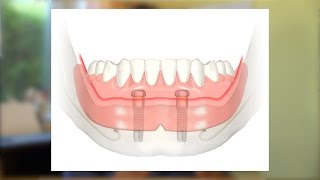 Eine kostengünstige Implantatlösung [upl. by Iliam]