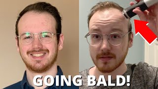 BALDING SO I SHAVED MY HEAD Transformation [upl. by Ydnyc494]