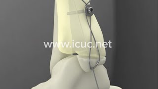 Medial Malleolus ORIF  ICUC® Video [upl. by Snave]