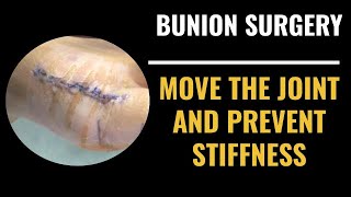 Recovering after bunion surgery how to move the joint and prevent stiffness [upl. by Loralee]