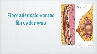 Fibroadenosis vs fibroadenoma medicohelpcom [upl. by Nesahc]