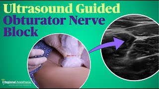 Ultrasound Guided Obturator Nerve Block [upl. by Eberle191]