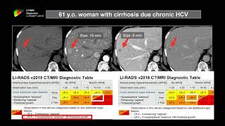 12 Pitfalls in Cirrhosis Imaging and User Errors in applying LIRADS  Part 2 Dr Khaled Elsayes [upl. by Nathalie]