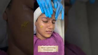 Yellow Peel Skin Lightening peelSkin Smile Clinic Bhopal ☎️ 9691918200skincare bhopal [upl. by Nahgeem]