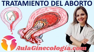 TRATAMIENTO DEL ABORTO EXPECTANTE vs MISOPROSTOL vs LEGRADO  Ginecología y Obstetricia [upl. by Carleen172]