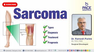 Sarcoma Cancer  Types Diagnosis Treatment amp Prognosis  sarcomatreatment [upl. by Asirehc]