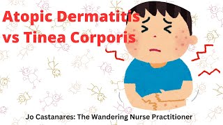 ⛑️ Atopic Dermatitis Eczema vs Tinea Corporis Ringworm jordanjowanderingpractitioner [upl. by Geddes]