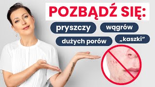 PRYSZCZE WĄGRY ŚWIECENIE  przyczyny i skuteczne metody na pozbycie się ich [upl. by Attiuqehs]