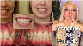 How To Straighten Teeth Naturally Exercises for Crooked Overjet Overbite Buck Teeth No Braces [upl. by Fey]