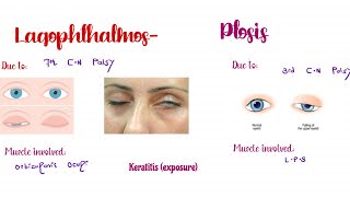 Lagophthalmos and PtosisWhat is the difference between them Ophthalmology [upl. by Latsyk]