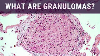 What are Granulomas  Pathology mini tutorial [upl. by Coughlin]