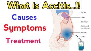 causes of ascites fluid in abdomen  treatment of ascites due to liver cirrhosis  ascites fluid [upl. by Claudelle756]