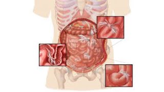 ADHERENCIAS ABDOMINALES [upl. by Sterner]