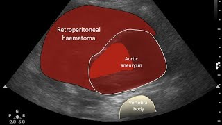 Abdominal Aortic Aneurysm Ultrasound [upl. by Sueaddaht]