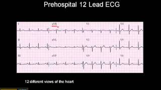 1215 Lead ECG The 12 Leads [upl. by Rapsac]