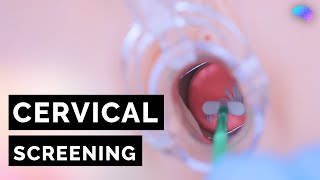 Cervical Screening Smear  HPV  OSCE Guide  UKMLA  CPSA [upl. by Tankoos]