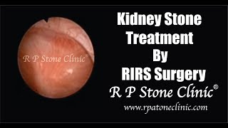 Kidney Stone treatment by RIRS Surgery  Flexible Ureteroscopy [upl. by Nywles]