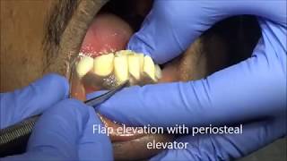 Supernumerary tooth extaction using forceps [upl. by Sharity]