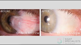 Pterygium surgery explained [upl. by Pinette]