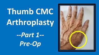 Thumb CMC Arthroplasty Part 1 PreOp Explanation cmc [upl. by Duarte]