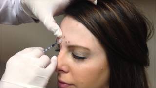 Allergan Botox Injections [upl. by Ellehcil531]