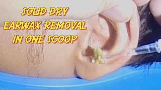 Solid Dry Earwax Removal in One Scoop [upl. by Steffen]