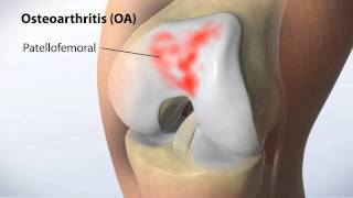 MAKOplasty Partial Knee Resurfacing [upl. by Rusert915]