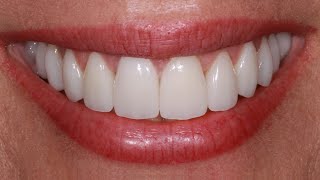 1 Thing to Consider for Dental Veneers [upl. by Kaela]