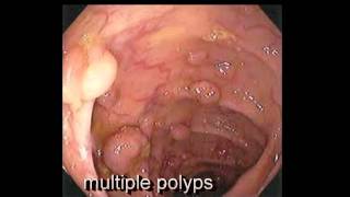 Colonoscopy FollowUp of Colon Polyp  Los Angeles Colonoscopy [upl. by Ettevol]