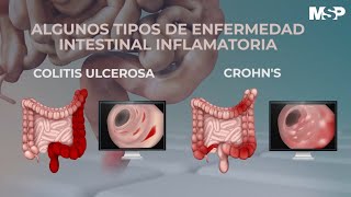 ¿Cómo tratar las enfermedades inflamatorias del intestino  ExclusivoMSP [upl. by Newo368]