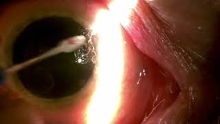 Slit lamp removal of corneal pannus by Steven G Safran MD [upl. by Arit]