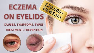 Eczema on Eyelids 2022  2023  Causes Symptoms Types Treatment and Prevention [upl. by Desi17]