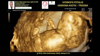 Hygroma Kistik  Hydrops Fetalis 12 Weeks  Trisomi [upl. by Mills]