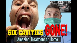 The Treatment for Tooth Decay that Reversed my 5 Cavities in 3 Months [upl. by Aneem]