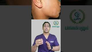 குழந்தைகளுக்கு ஏற்படும் தேமல்  தீர்வு என்ன  Pityriasis alba treatment தேமல் சிகிச்சை முறை [upl. by Kan]