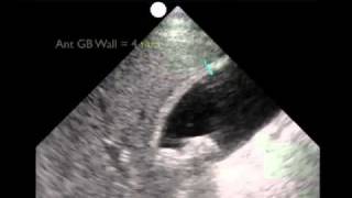 How To Gallbladder Ultrasound Part 3  Acute Cholecystitis Case Study Video [upl. by Kerad623]