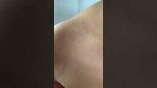 Pityriasis Rosea  Sanjeevani Skin Clinic India [upl. by Anitnatsnoc]