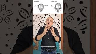 सिर में यह गैप कैसे आ गया Post Craniectomy Bone Defect NeuroMedTalks01 neurosurgeon brain [upl. by Jessey]