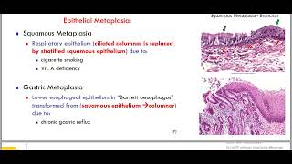 hypertrophy metaplasia [upl. by Drofliw149]