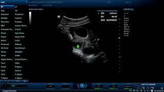 Dichorionic twins and two corpus luteum cysts Diagnostic ultrasound cases [upl. by Meador614]